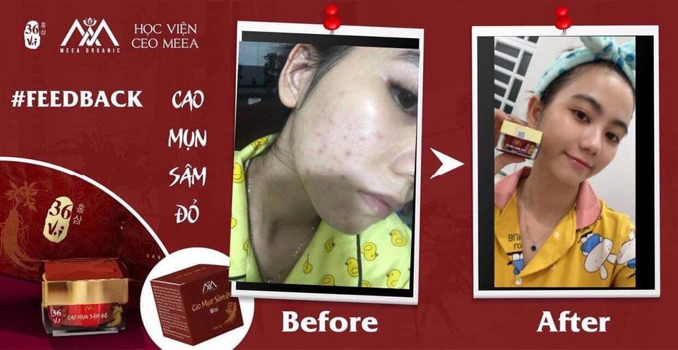 Cao Mụn Sâm Đỏ 36 Vị Thuốc Bắc - Vua Trị Mụn An Toàn