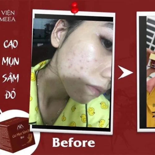 Cao Mụn Sâm Đỏ 36 Vị Thuốc Bắc - Vua Trị Mụn An Toàn