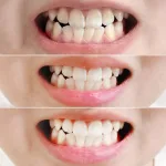 Kem Đánh Răng Median Màu Đỏ Dental IQ 93% Tartar Toothpaste Badbreath 120g