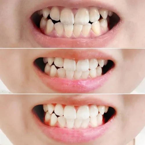 Kem Đánh Răng Median Màu Đỏ Dental IQ 93% Tartar Toothpaste Badbreath 120g