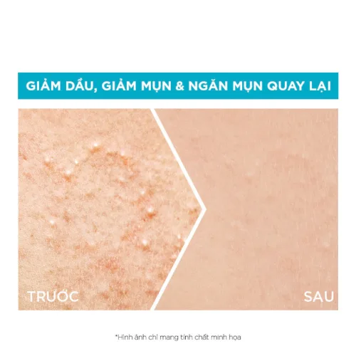 Serum Garnier Giảm Mụn Sáng Da Skin Naturals Bright Complete Anti-Acne Booster Serum 30ml
