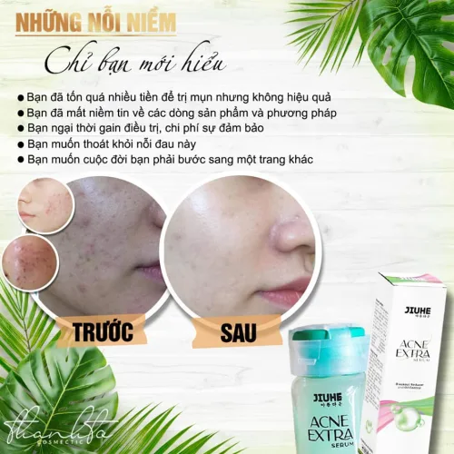Serum giảm Mụn Jiuhe Acne Extra Thanh Tô Cosmetics