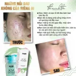 Serum giảm Mụn Jiuhe Acne Extra Thanh Tô Cosmetics