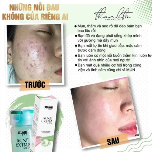 Serum giảm Mụn Jiuhe Acne Extra Thanh Tô Cosmetics