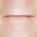 Tinh Chất Ủ Mụn Đầu Đen ILSO Super Melting Sebum Softener 150g Giúp Sạch Bã Nhờn Sáng Da