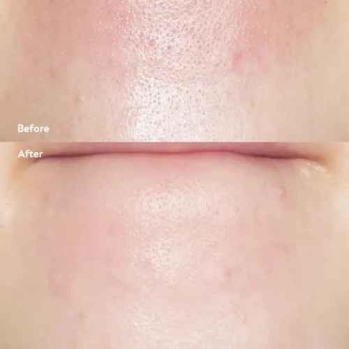 Tinh Chất Ủ Mụn Đầu Đen ILSO Super Melting Sebum Softener 150g Giúp Sạch Bã Nhờn Sáng Da