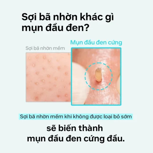 Tinh Chất Ủ Mụn Đầu Đen ILSO Super Melting Sebum Softener 150g Giúp Sạch Bã Nhờn Sáng Da
