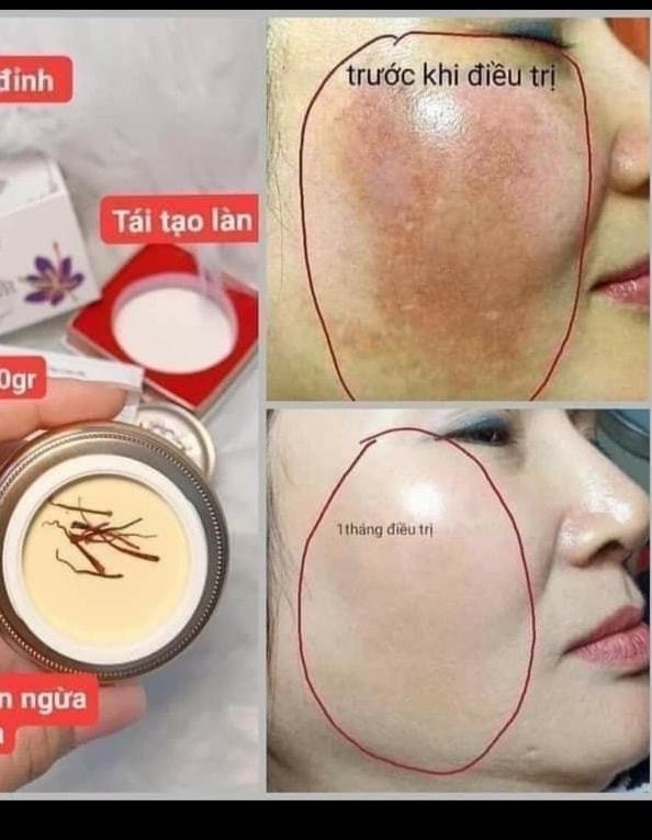 Kem Face Trị Nám Dưỡng Trắng Da Saffron Napoli Hải Âu Việt