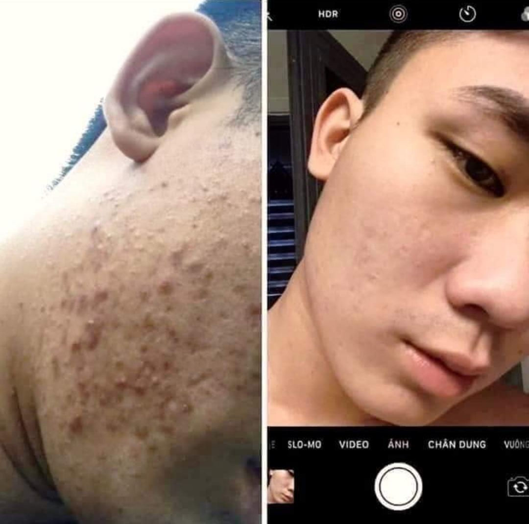 Đừng để mụn cản trở cuộc sống của bạn!