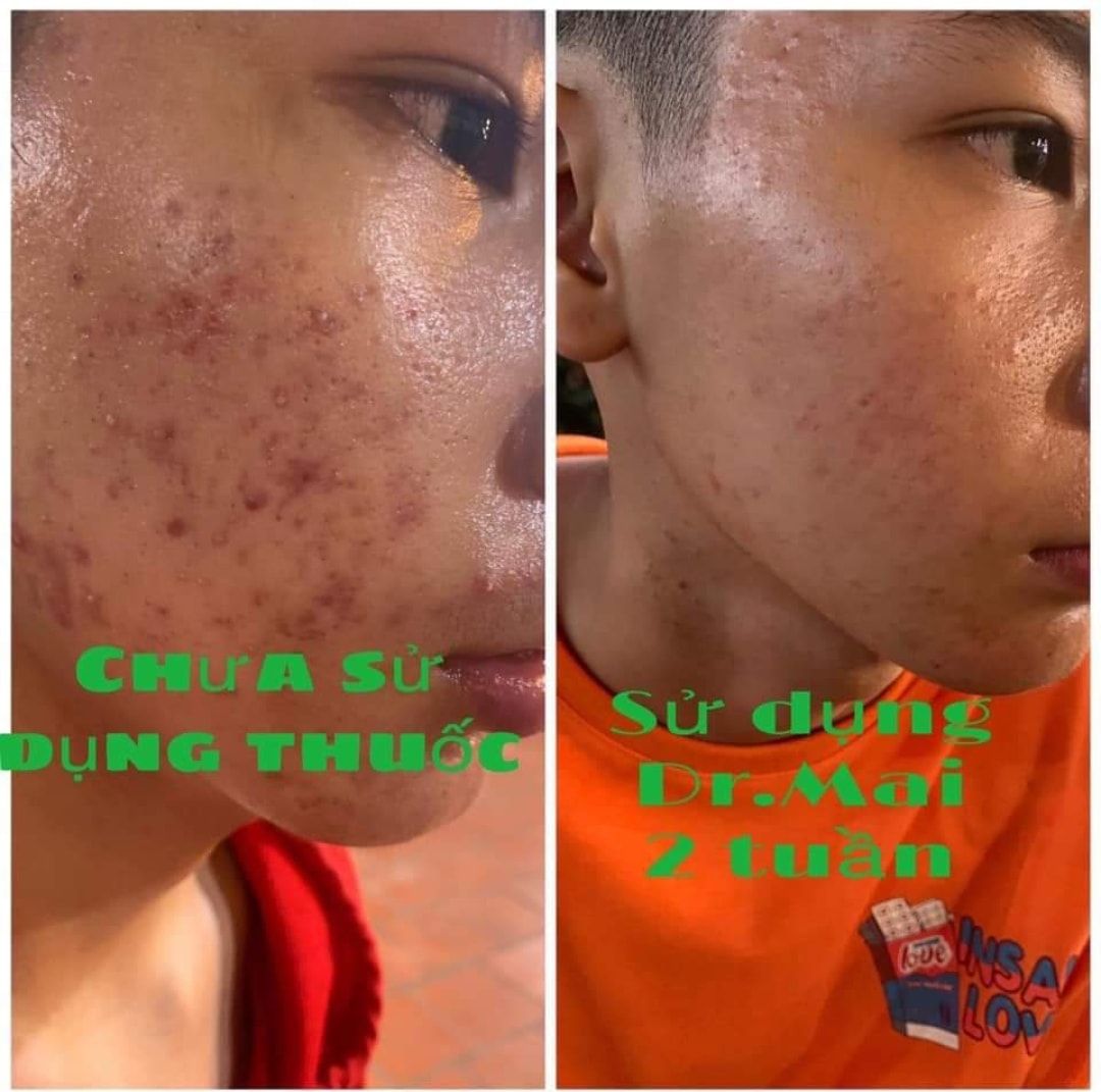 Đừng để mụn cản trở cuộc sống của bạn!
