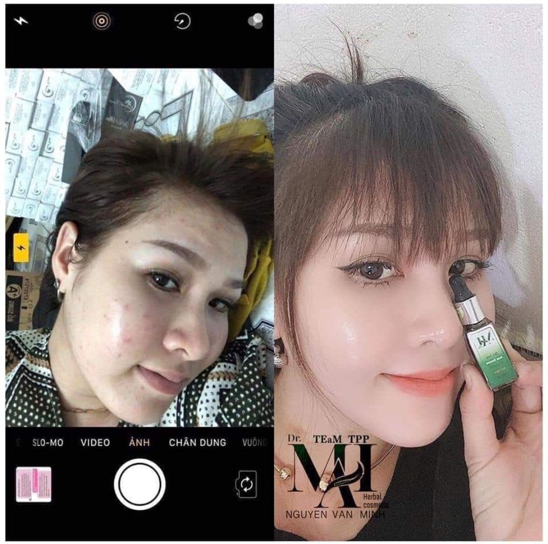 Đừng để mụn cản trở cuộc sống của bạn!