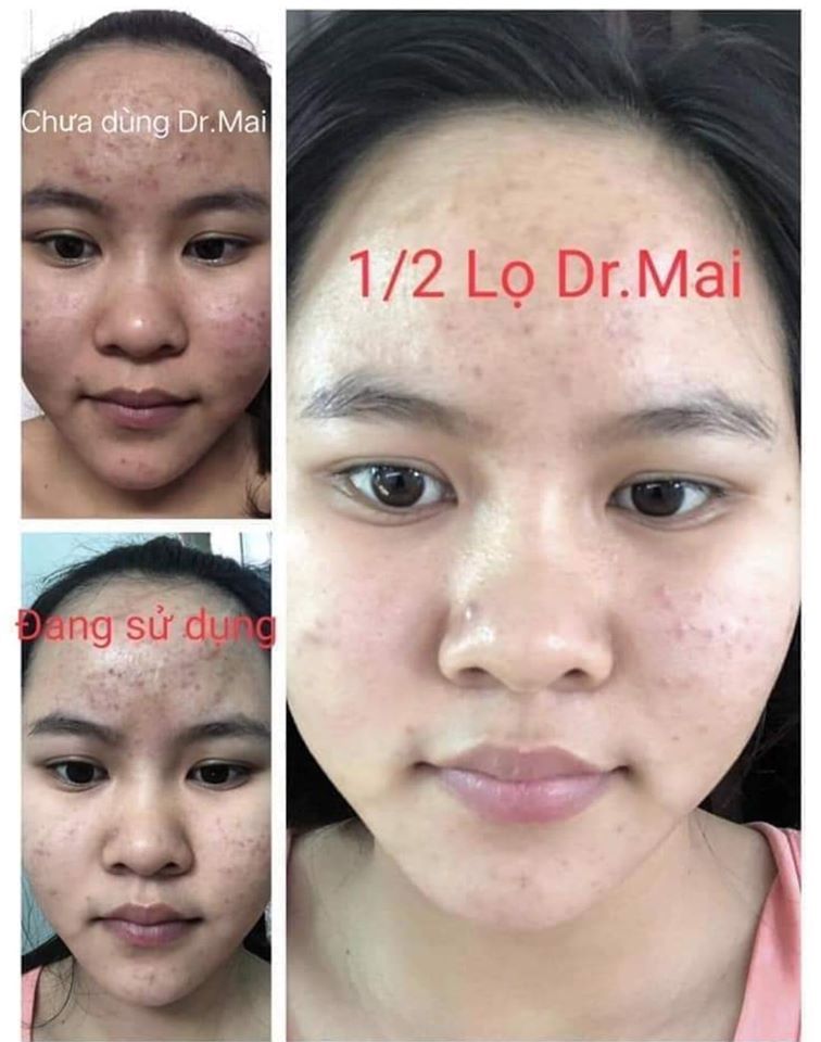 Đừng để mụn cản trở cuộc sống của bạn!