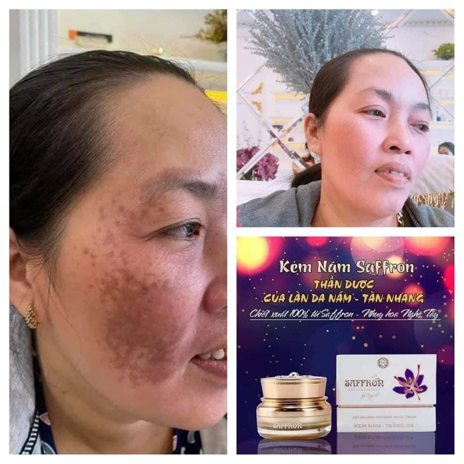 Feedback Kem Trị Nám Dưỡng Trắng Da Saffron Napoli Hải Âu Việt