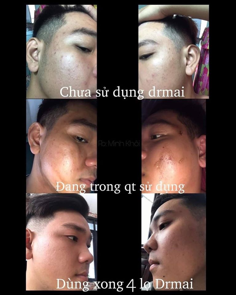 Trị mụn DR Mai vừa hợp túi tiền - vừa an toàn hiệu quả