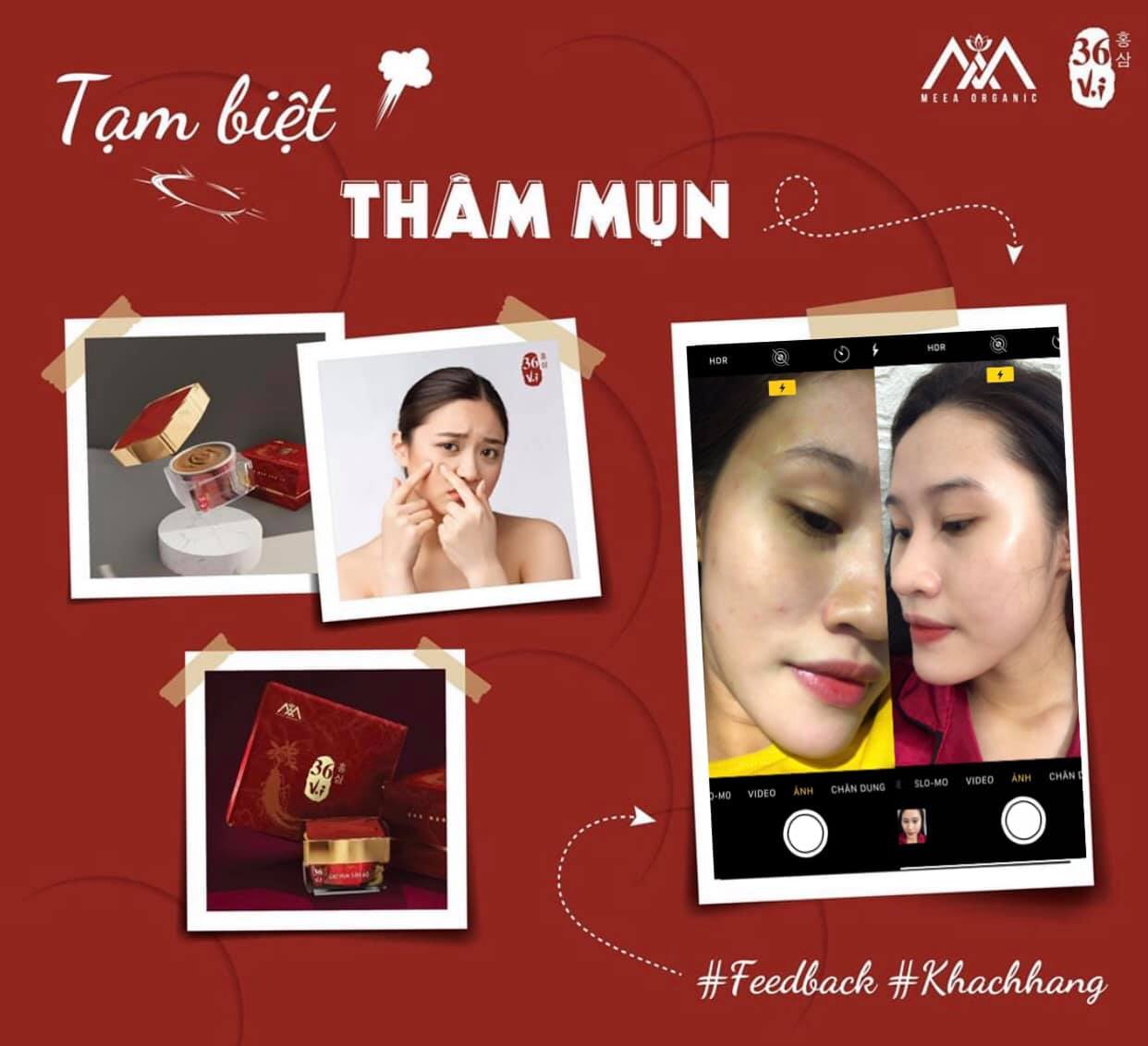 Thảo dược trị mụn Cao Mụn Sâm Đỏ